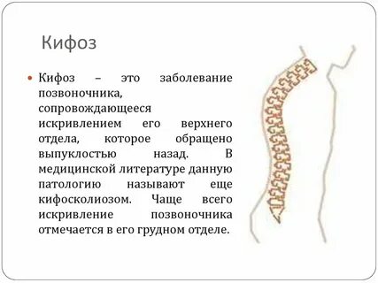 Лордоз кифоз сколиоз