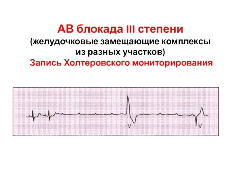 Комплекс блокада. Синоатриальная блокада на ЭКГ. АВ блокада 3 степени на ЭКГ. Синоатриальная блокада 3 степени на ЭКГ. Атриовентрикулярная блокада 3 степени клиника.