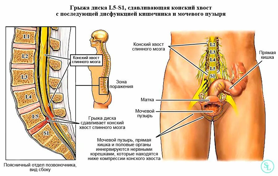 Можно вылечить грыжу без операции