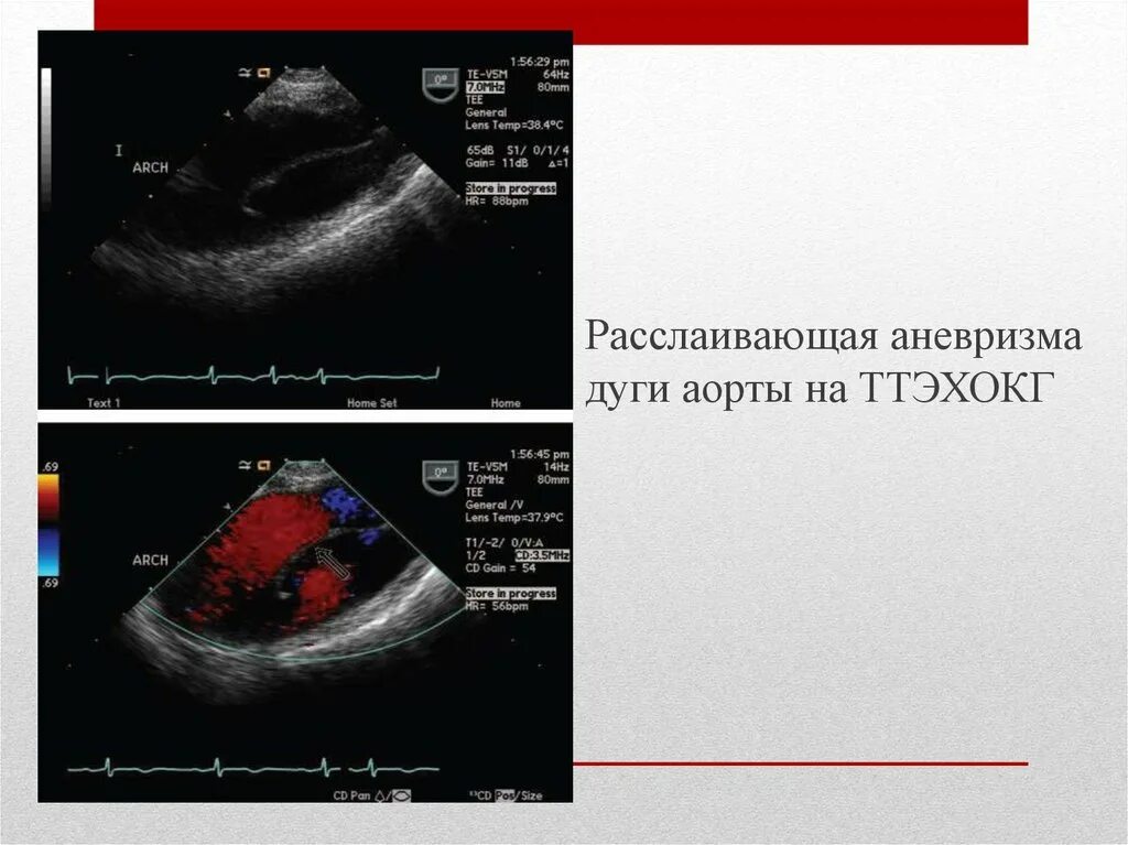 Аневризма брюшного отдела аорты на узи. Абдоминальная аортальная аневризма это. Узи заключение брюшного отдела аорты с аневризмой. Узи признаки аневризмы аорты. Узи брюшной аорты протокол.