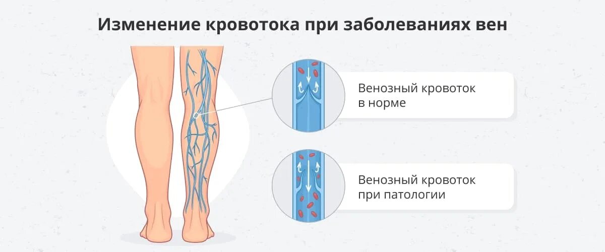 Варикозная болезнь вен нижних конечностей описание. Осложнения варикозной болезни вен нижних конечностей. Варикозное расширение вен (врв) нижних конечностей. Варикозная болезнь вен нижних конечностей стадии. Заболевания вен нижних конечностей лечение.