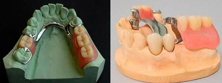 бюгельный протез зубов. бюгельный протез а16. припасовка каркаса бюгельного протеза. многозвеньевой шинирующий бюгельный протез. полиуретановый бюгельный протез.