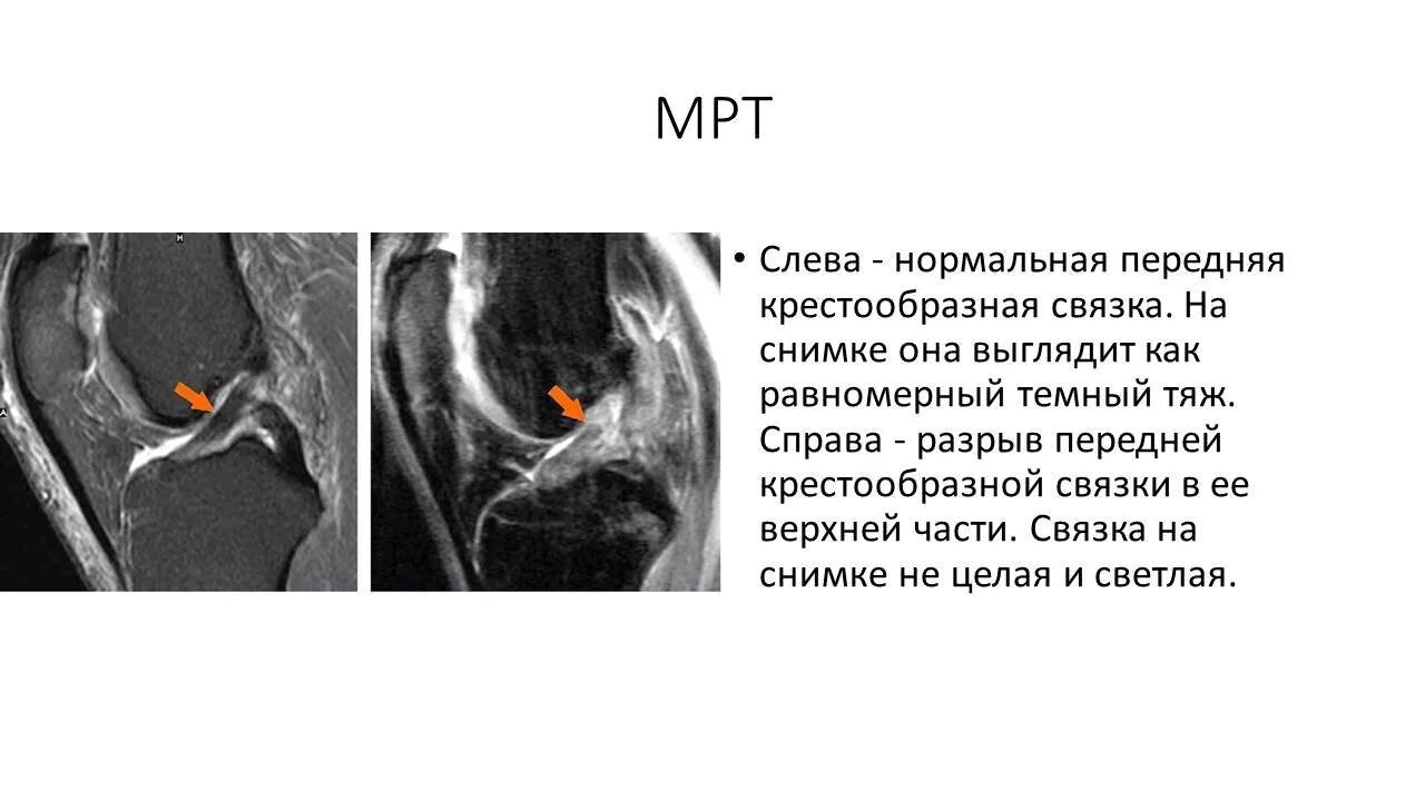 Разрыв пик. Мрт коленного сустава повреждение крестообразной связки. Растяжение передней крестообразной связки мрт. Разрыв крестообразной связки коленного сустава на мрт. Разрыв ПКС коленного сустава на мрт.