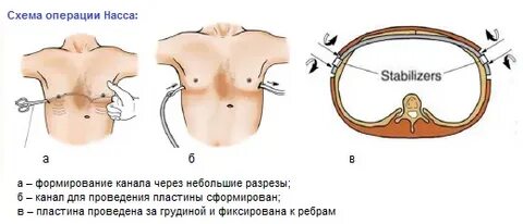 Сколько длится операция на легкие