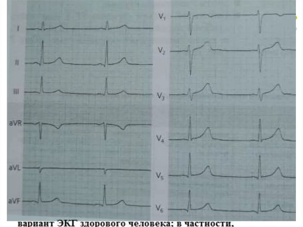 Нарастание зубца r. Элевация сегмента St на ЭКГ. Элевация St в v1-v3. Элевация это в ЭКГ. Элевация т на ЭКГ.