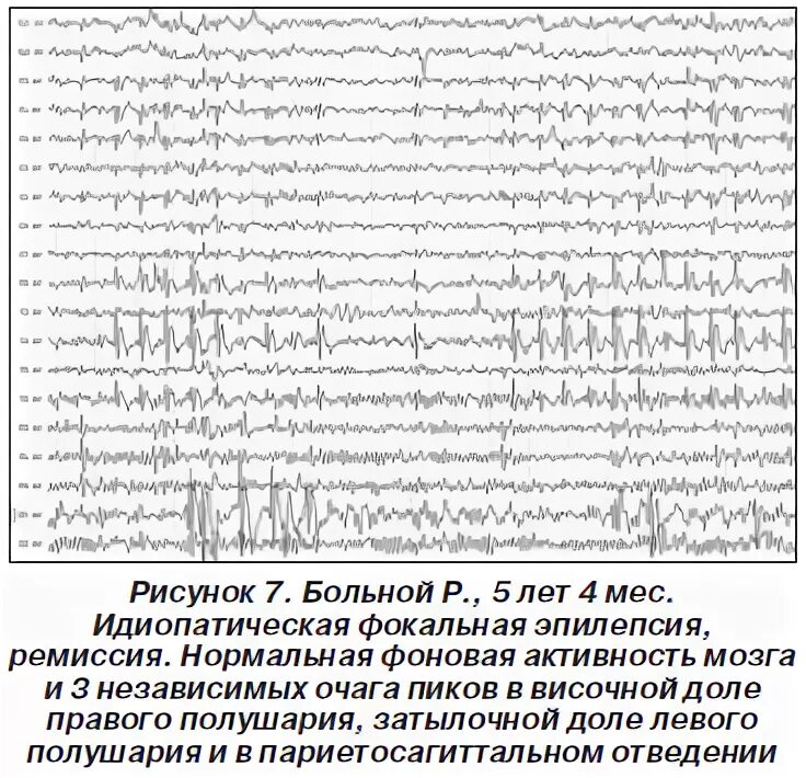 Ээг показывает эпилепсию