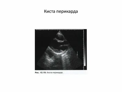 Киста перикарда