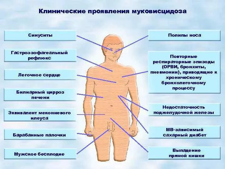 Как проявляется легкая форма. Муковисцидоз у детей клинические рекомендации 2022. Муковисцидоз клинические признаки. Клинические симптомы муковисцидоза. Муковисцидоз основные клинические проявления.