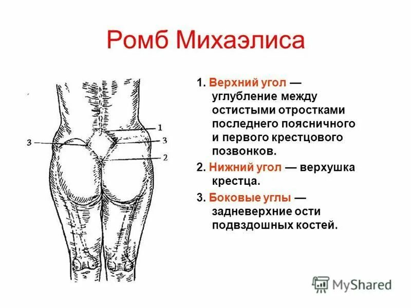 Верхушка ромба михаэлиса. Исследование ромба михаэлиса (пояснично-крестцового). Верхний угол ромба михаэлиса. Верхний угол ромба михаэлиса. Измерение ромба михаэлиса алгоритм.