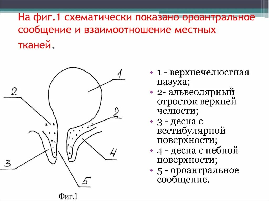 Ороонтальное сообщение это. Способы закрытия ороантральных сообщений. Закрытие ороантрального сообщения вестибулярным лоскутом. Закрытие ороантрального сообщения методики. Цистоэктомия