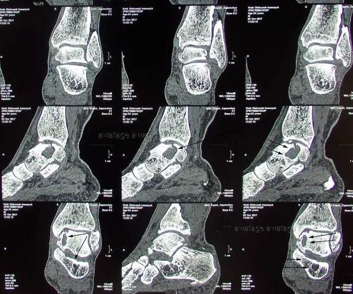 Асептический некроз таранной кости кт. Асептический некроз таранной кости мрт. Таранная кость асептический некроз. Стадии асептического некроза таранной кости кт. Контузионные изменения кости