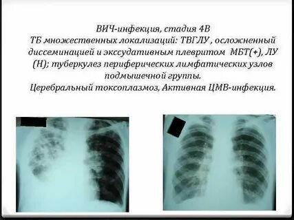 Туберкулез легких при вич