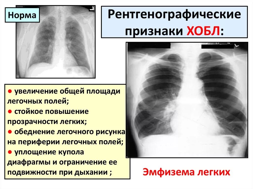 Бронхит хобл. Рентген при ХОБЛ эмфизема. Хронический обструктивный бронхит рентген. Рентген грудной клетки ХОБЛ. Рентгенография лёгких при ХОБЛ.