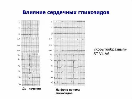 Интоксикация на экг