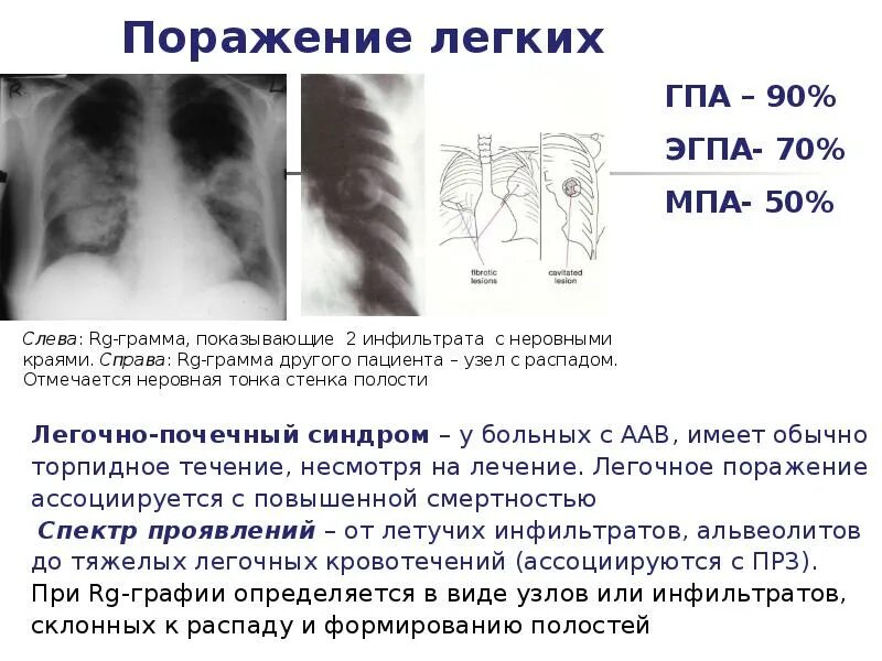 3 поражения легких