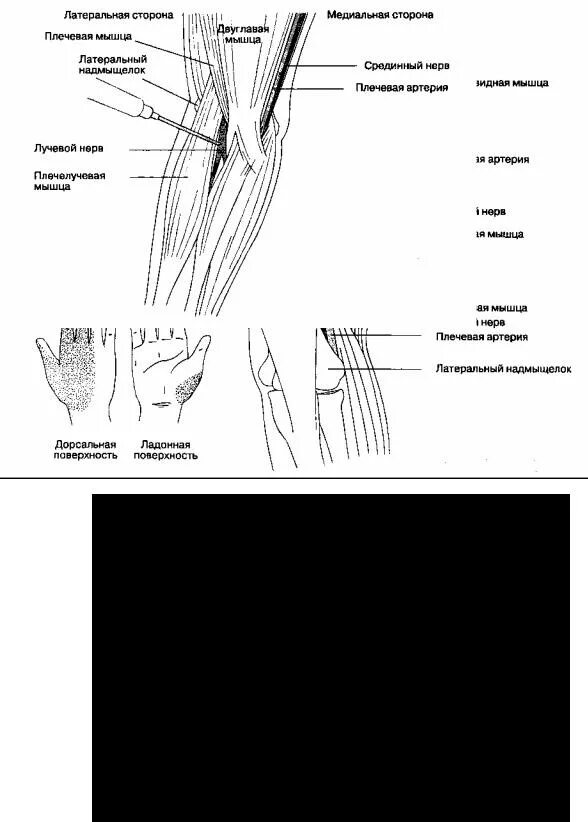 Блокада периферических нервов анестезиология. Проводниковая анестезия локтевого нерва. Проводниковая анестезия лучевого и локтевого нервов. Блокада лучевого локтевого срединного нервов.