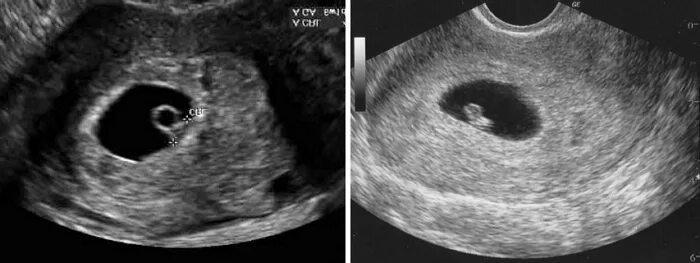 Миома матки на УЗИ 7 недель. Желточный мешок на 5 неделе беременности. Желточный мешок на 7 неделе беременности. Шейка 6 недель