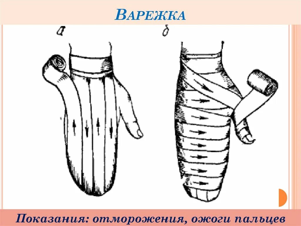 Рыцарская перчатка алгоритм. Наложение повязки варежка. Наложение повязки варежка алгоритм. Технология наложения повязки варежка. Наложение повязки на кисть варежка.