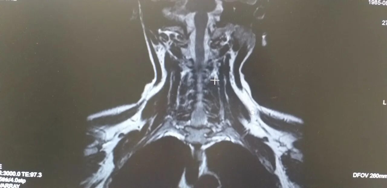 Грыжа шейного отдела с4-5,с5-6. Радикулопатия с4-с5. Грыжа диска с5 с6 с6 с7. Грыжа 5 и 6 позвонков шейного отдела. Грыжа дисков с5 с6.
