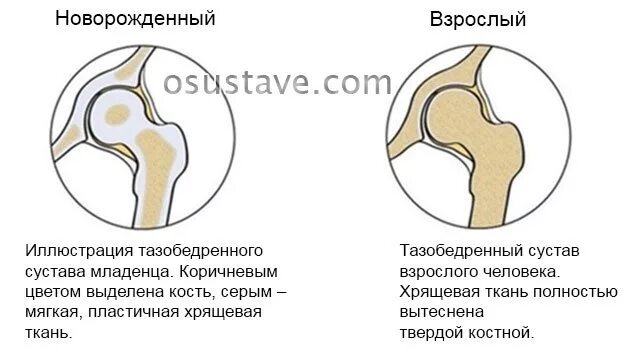 Дисплазия сустава у новорожденного лечение