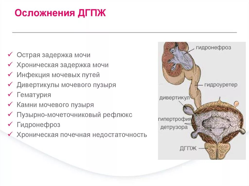 Доброкачественная Узловая гиперплазия предстательной железы. Дивертикул мочевого пузыря классификация. Доброкачественная гиперплазия предстательной железы (ДГПЖ). Степени простатита