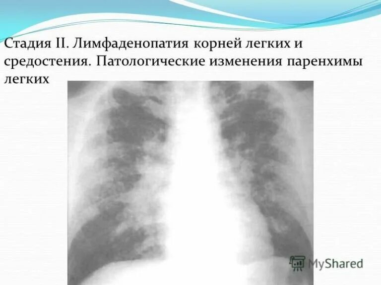 Аденопатия. Лимфаденопатия внутригрудных лимфоузлов рентген. Лифоаденомопотия средостения. Количественная лимфаденопатия средостения.