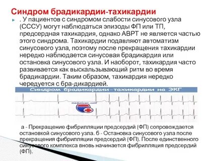 Синдром слабости синусового узла на экг