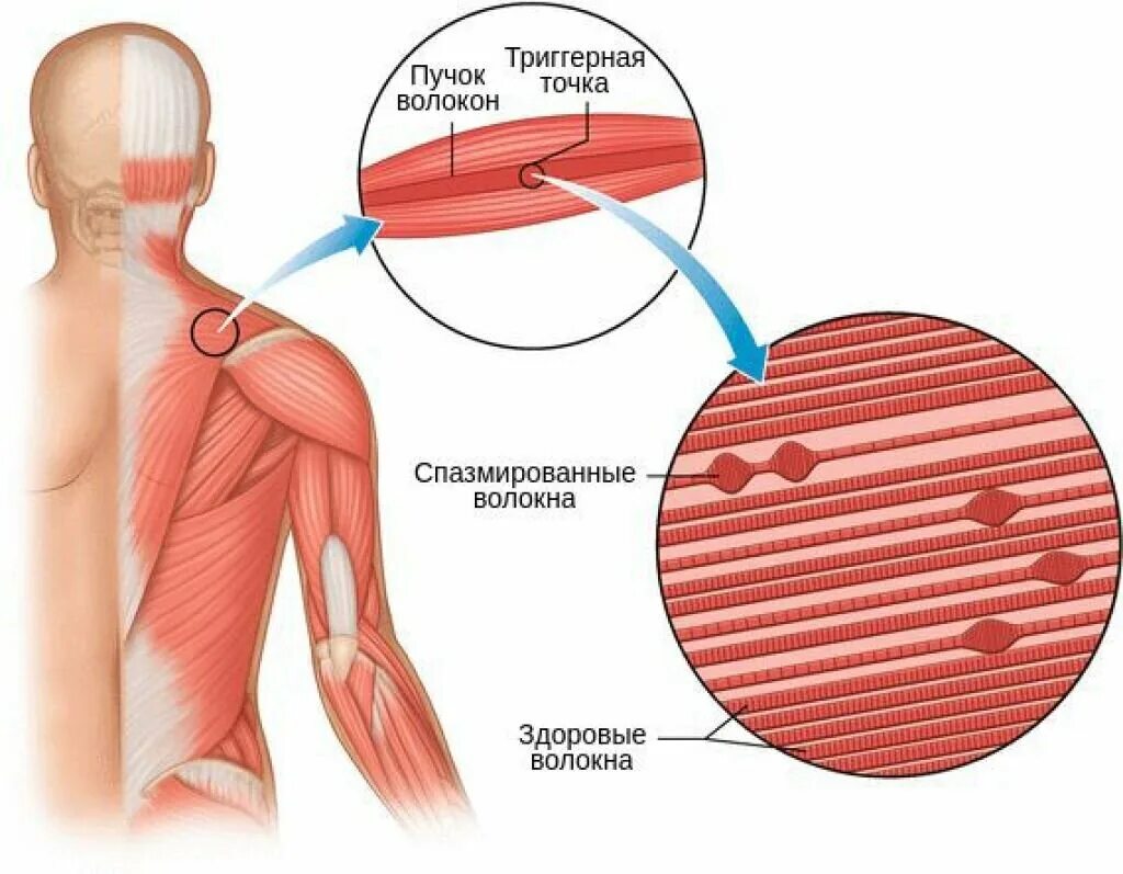 Триггерные точки это простыми словами. Миофасциальный синдром мышц. Триггеры в мышцах. Миофасциальный болевой синдром. Триггерная точка в мышцах.