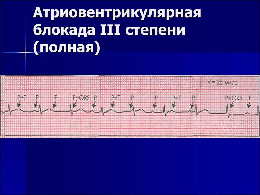 Полная атриовентрикулярная блокада