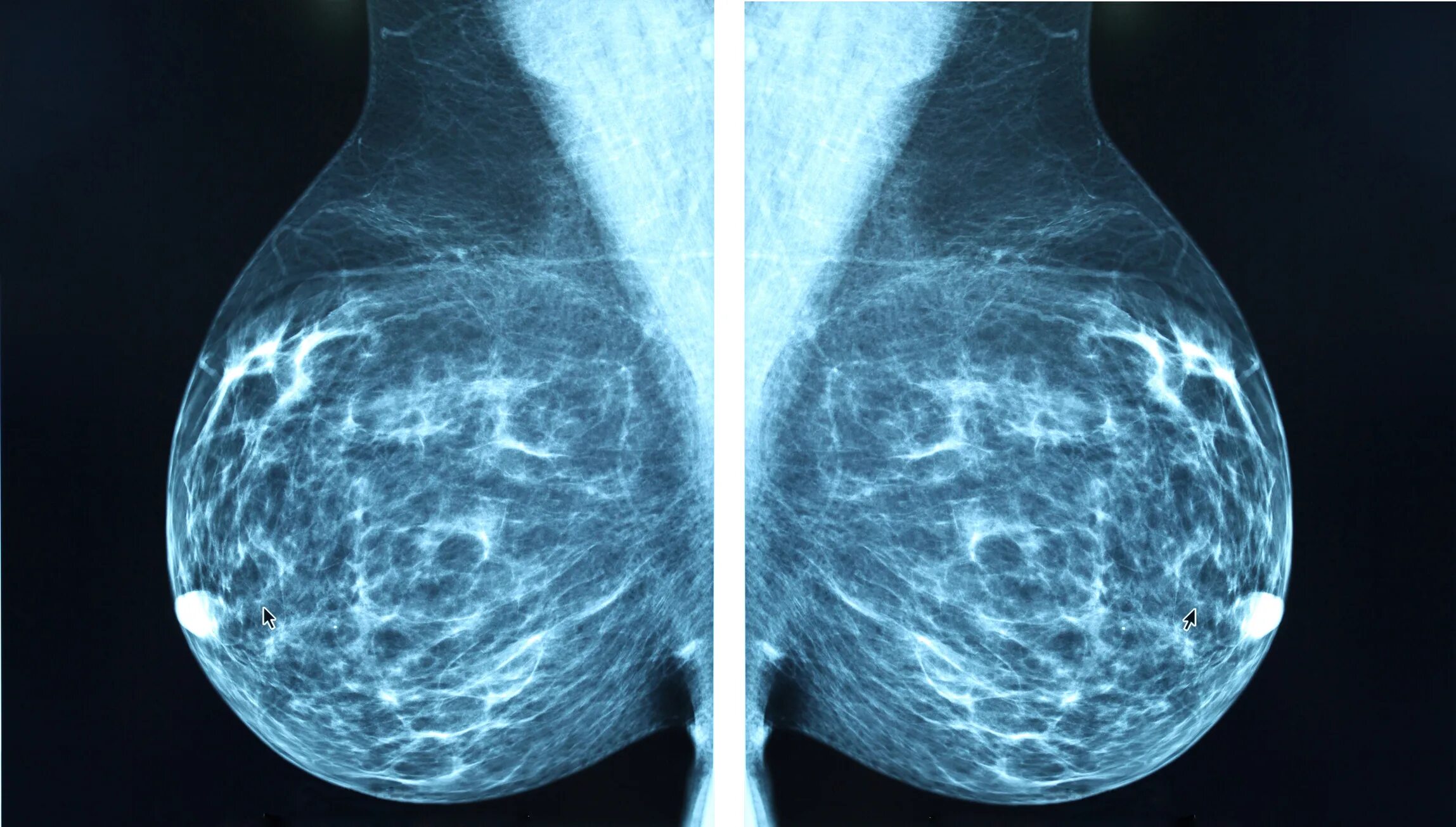 На фоне фиброзных изменений. Фиброзно-кистозная мастопатия маммография. Фиброзно кистозная мастопатия маммограмма. Маммография рентген снимки. Рентген молочных желез маммография аппарат.