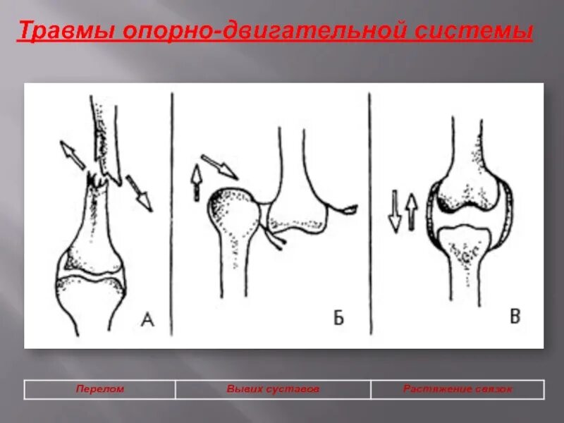 Переломы вывихи растяжения связок ушибы. Растяжения, вывихи, ушибы, переломы. повреждения скелета вывихи, растяжения, переломы. вид травмы растяжение вывих перелом. травмы костей вывихи растяжения перелома.