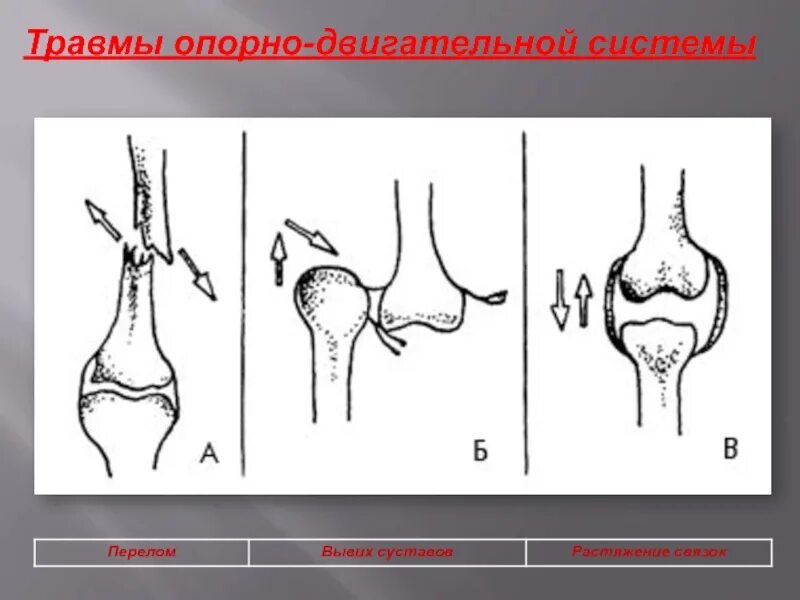 Разрыв кости. Растяжения, вывихи, ушибы, переломы. Повреждения скелета вывихи, растяжения, переломы. Перелом вывих растяжение.