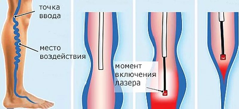 Что значит расширение вен. Эндовазальная лазерная коагуляция вен. Эндовенозная облитерация вен. Эндовенозная лазерная облитерация вен нижних конечностей. Лазерная облитерация (коагуляция) вен.