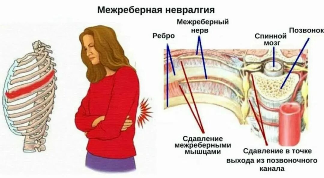 Межреберная невралгия слева симптомы причина лечение. Межреберная невралгия в области сердца симптомы. невралгия межреберного нерва. блокада нерва при межреберной невралгии. меж ребер невралгия симптомы.