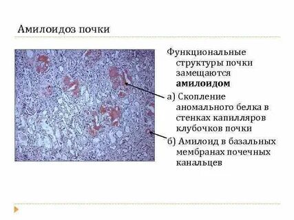 Почечный амилоидоз