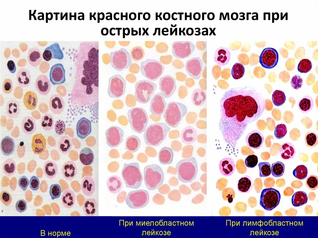 Патанатомия острого лимфобластного лейкоза. Ювенильный миеломоноцитарный лейкоз картина крови. Классификация лейкозов. Бласты в костном мозге при остром лейкозе.