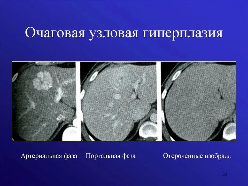 Фиброзно-нодулярная гиперплазия печени. Нодулярная гиперплазия печени у собаки узи. Фокальная нодулярная гиперплазия это. Фокальная нодулярная гиперплазия это. Фиброзно-нодулярная гиперплазия печени.