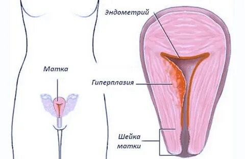 Гиперплазия цервикального канала