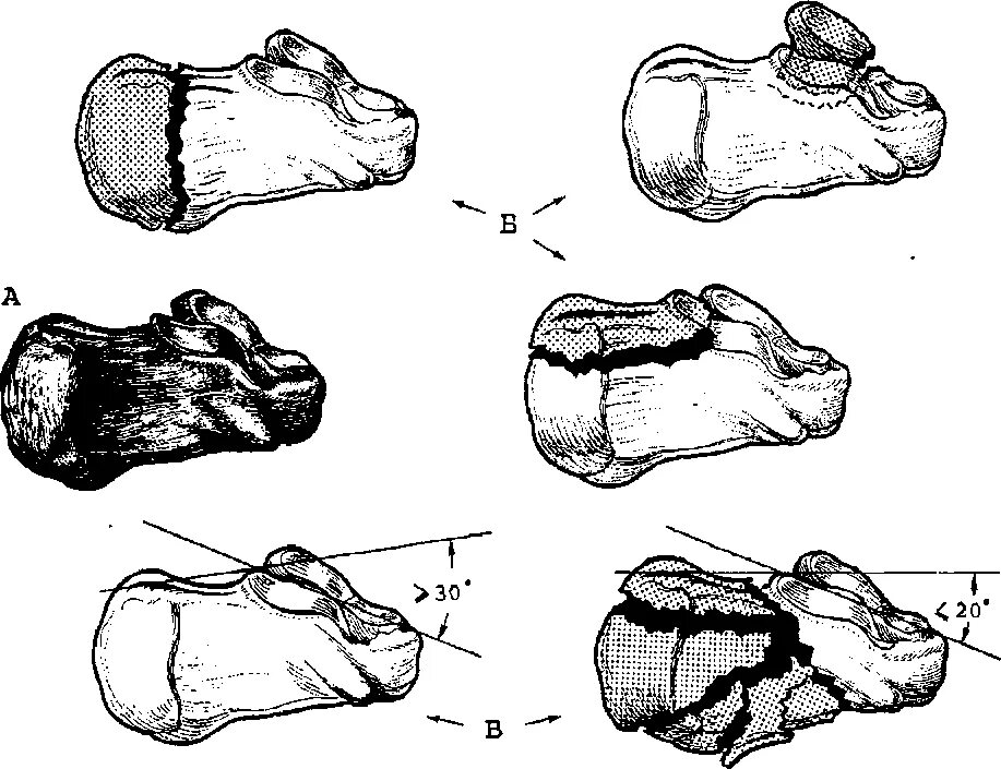 Операция пяточной кости. Перелом пяточной кости таранная кость. Перелом пяточной кости остеосинтез. Импрессионный перелом пяточной кости. Переломы пяточной кости классификация.
