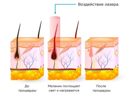 Лазерная эпиляция вызывает рак