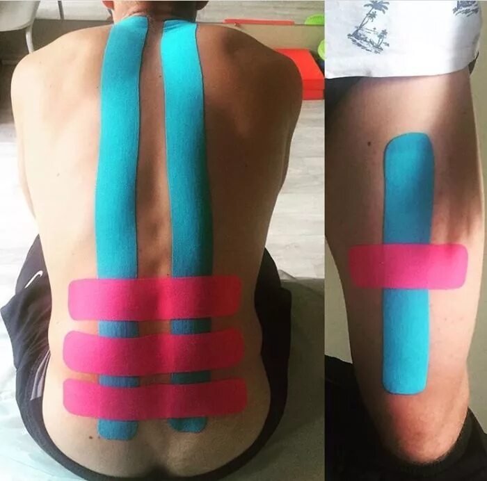 Кинезио тейп Kinesio. Кинезиотерапия тейпирование. Тейпирование тазобедренного сустава. Тейпирование кинезио лимфодренаж.