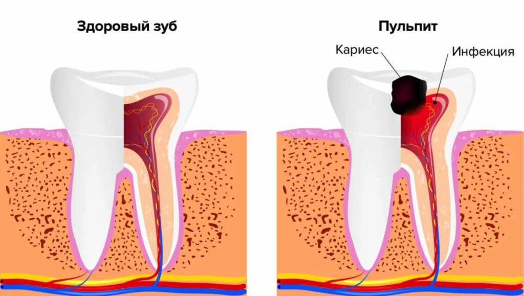 После удаления нерва болит зуб при нажатии