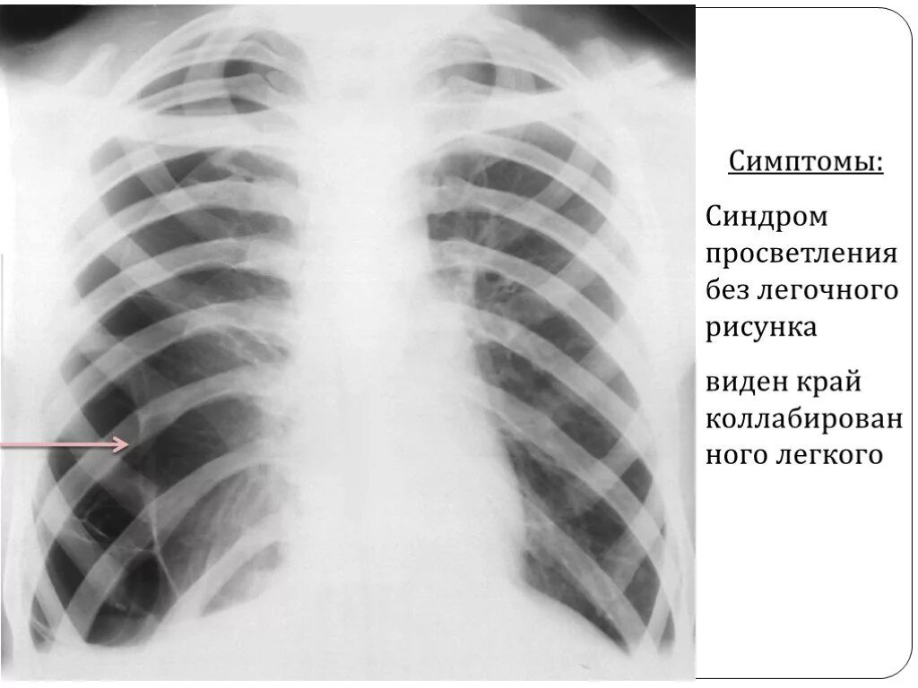 Коллабирование это. Пневмоторакс лёгких рентгенограмма просветление. коллабированное легкое. коллабирование легкого рентген. синдром обширного просветления легочного поля.
