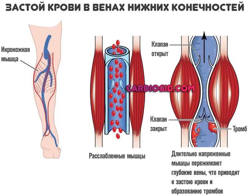 Образования тромбов в нижних конечностях (тромбоз глубоких вен). Тромбоз мышечных вен голени. Тромбоз сосудов нижних конечностей бедра. Варикозное расширение вен (ВРВ) нижних конечностей. Механизмы тромбов