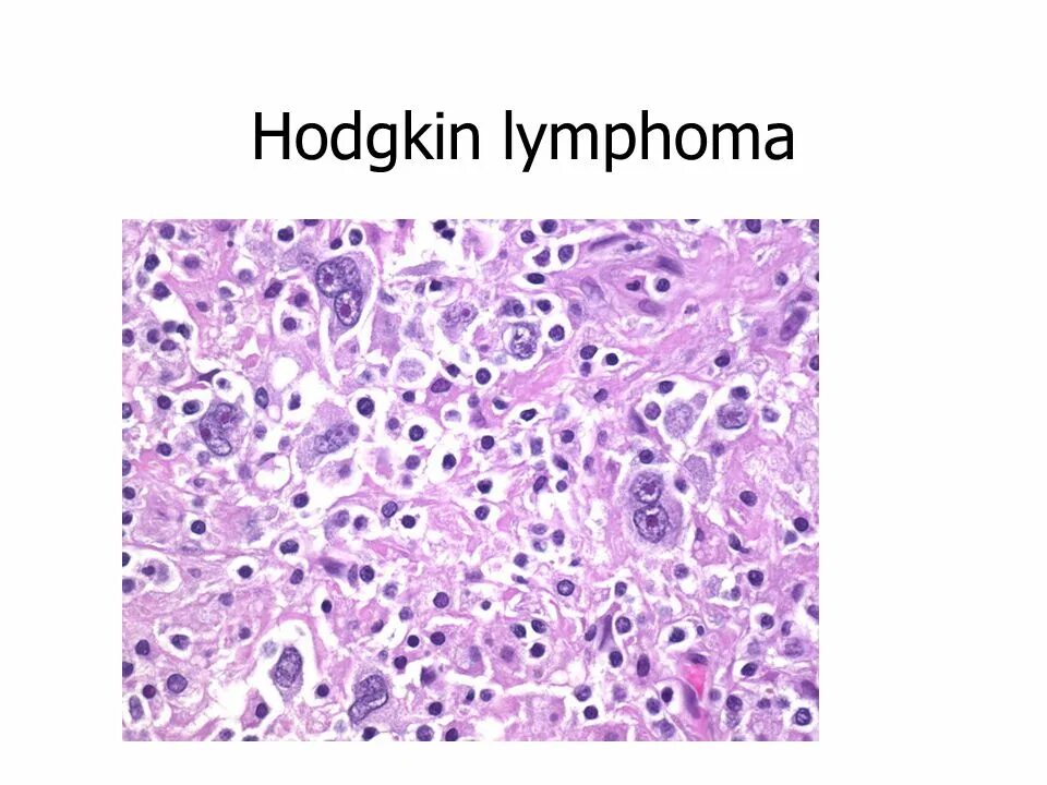 Медиастинальная в крупноклеточная лимфома. Лимфома Ходжкина микропрепарат. Генерализованная лимфома Ходжкина. Крупноклеточная лимфома гистология.
