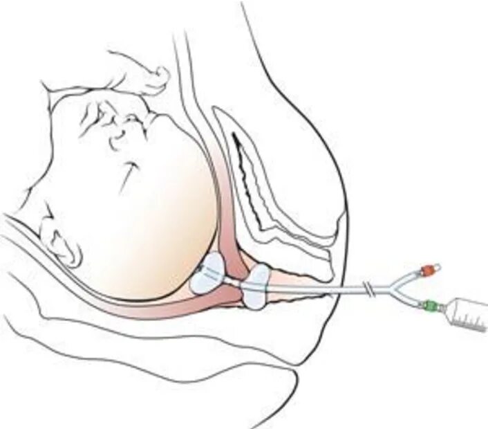 Что такое катетер Фолея для беременных. Катетер Фолея для шейки. Катетер Фолея для стимуляции шейки.