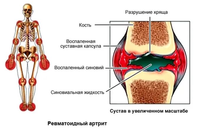 Питание суставного хряща. Ревматоидный артрит суставы. Болят кис