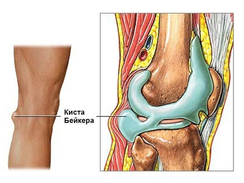 Подколенная киста коленного сустава