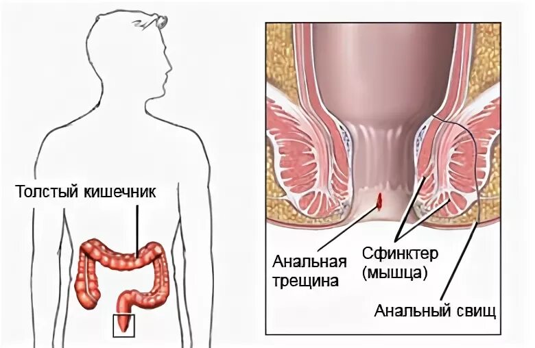 Снять спазм сфинктера при трещине. Сфинктеротомия внутреннего сфинктера. Внутренний анальный сфинктер. Анальная трещина на сфинктере. Сфинктер анального прохода.