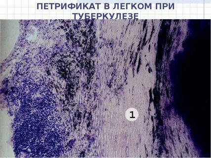 Первичный туберкулезный аффект